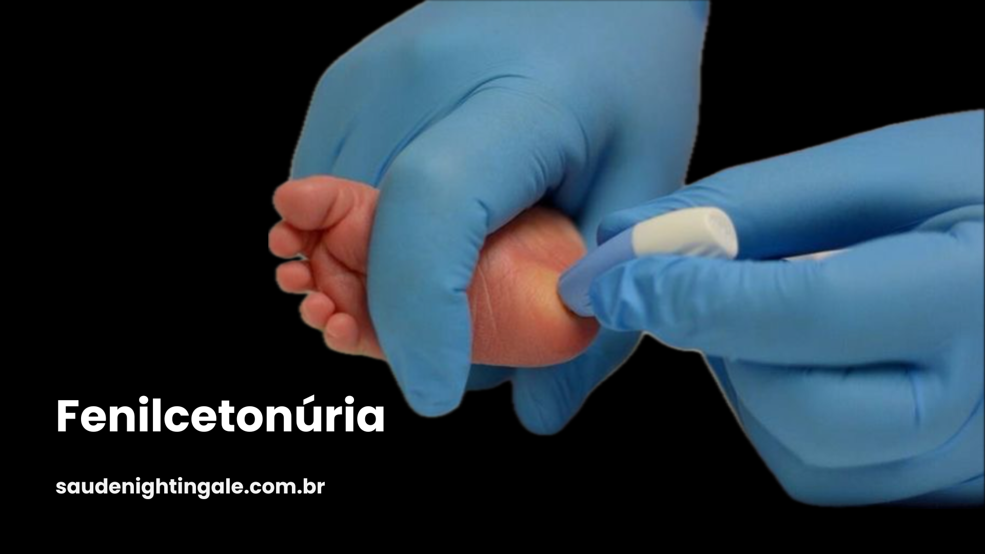 Fenilcetonúria: fisiopatologia, diagnóstico precoce e cuidado ao longo da vida