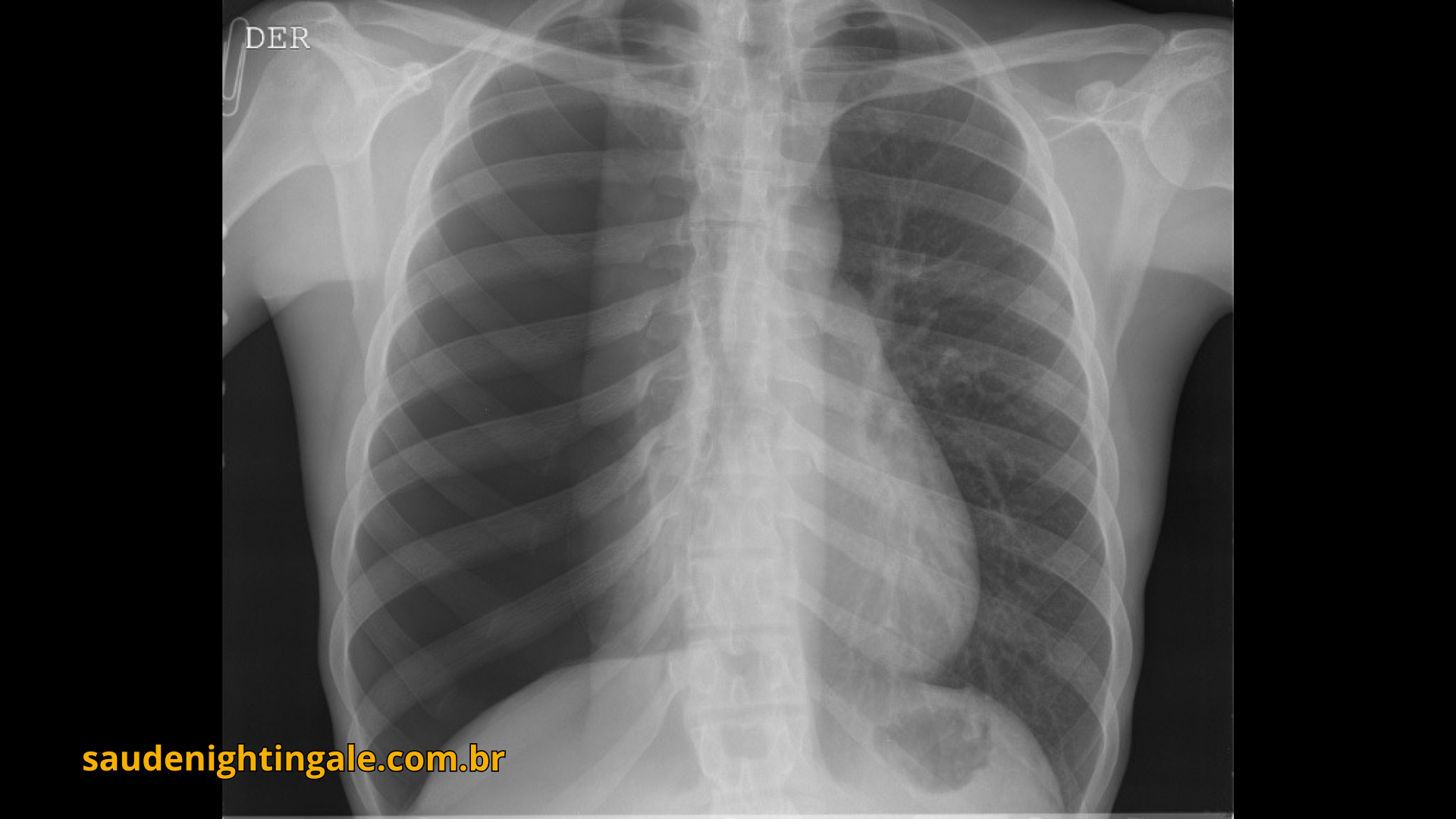 Hipertensão Pulmonar: fisiopatologia, diagnóstico e manejo clínico