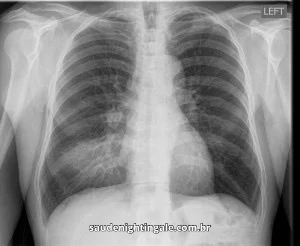 Pneumonia: fisiopatologia, manifestações clínicas, diagnóstico e cuidado contínuo